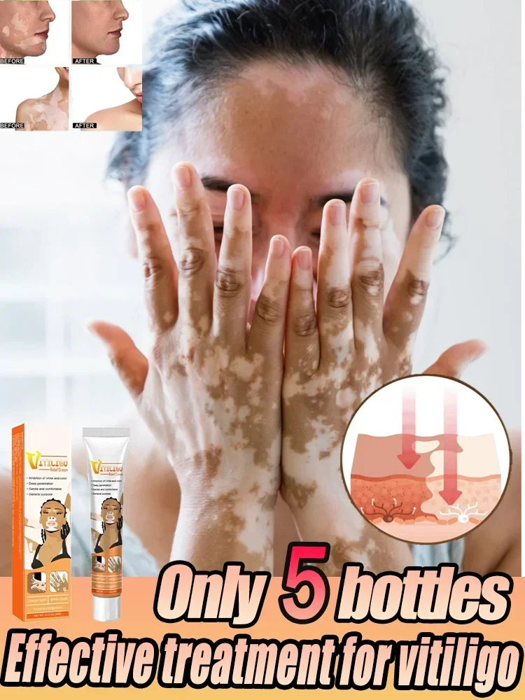 

Vitiligo White Spot Repair Cream Face Body Discoloration Skin Vitiligo Cream