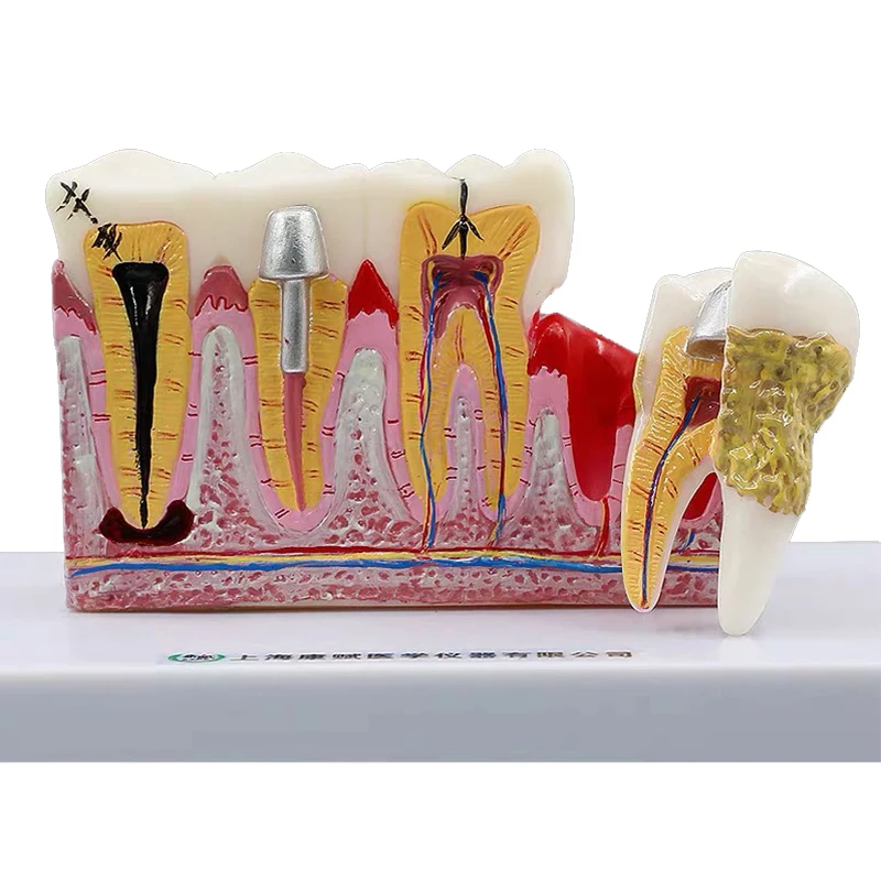 

1pcs Dental Tooth Teeth Anatomical Model Caries Oral Dental Anatomy Demonstration Medical Teaching Tools