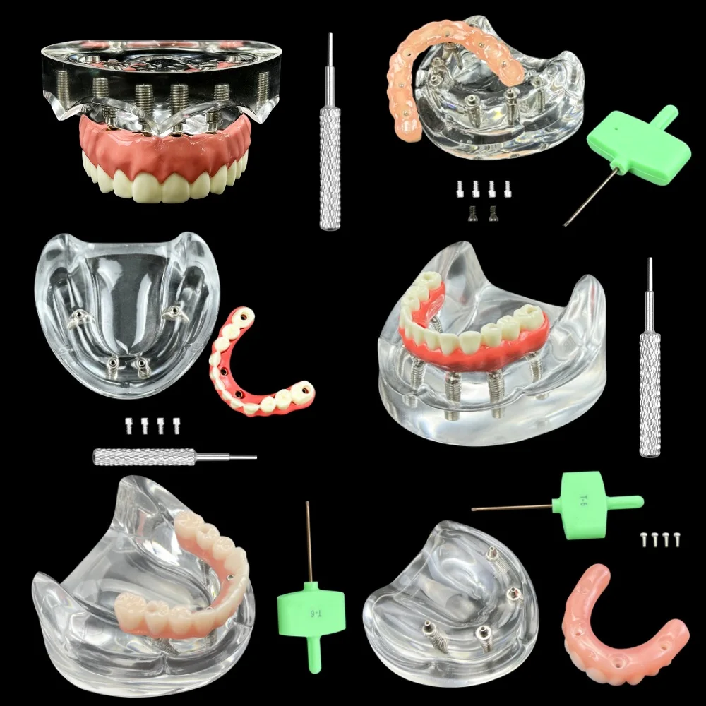 

4/6 Implants Overdenture Restoration Model Dental Upper/Lower Jaw Removable Teeth Model for Educational Practice Training Study