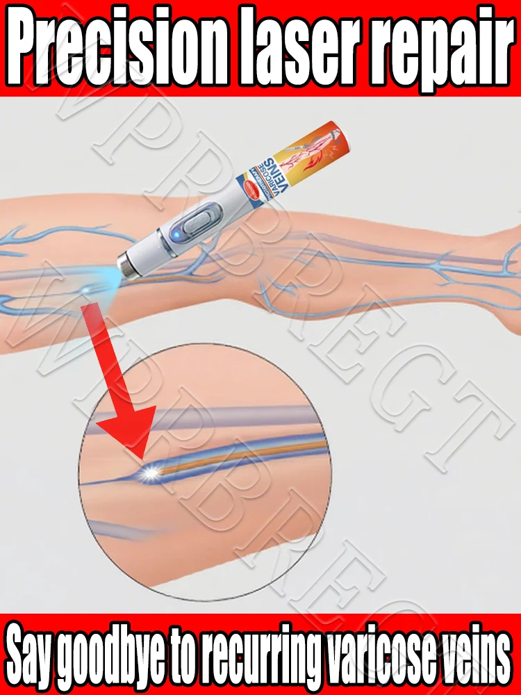 

Dilated veins cause leg abnormalities and pain. 2nd generation laser treatment, safe and painless