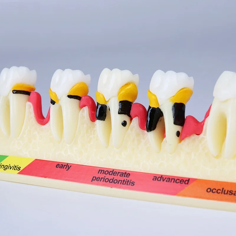 Dental Disease Model M4010 Caries Demo Model Demonstrates Progress of Periodontal Disease Dental Study Teeth Model for Dentist