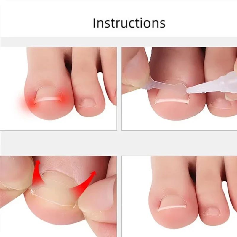 10 pezzi trattamento delle unghie dei piedi incarnite strumento di correzione dell'unghia del piede incarnita adesivo patch elastico raddrizzamento clip tutore strumenti per pedicure