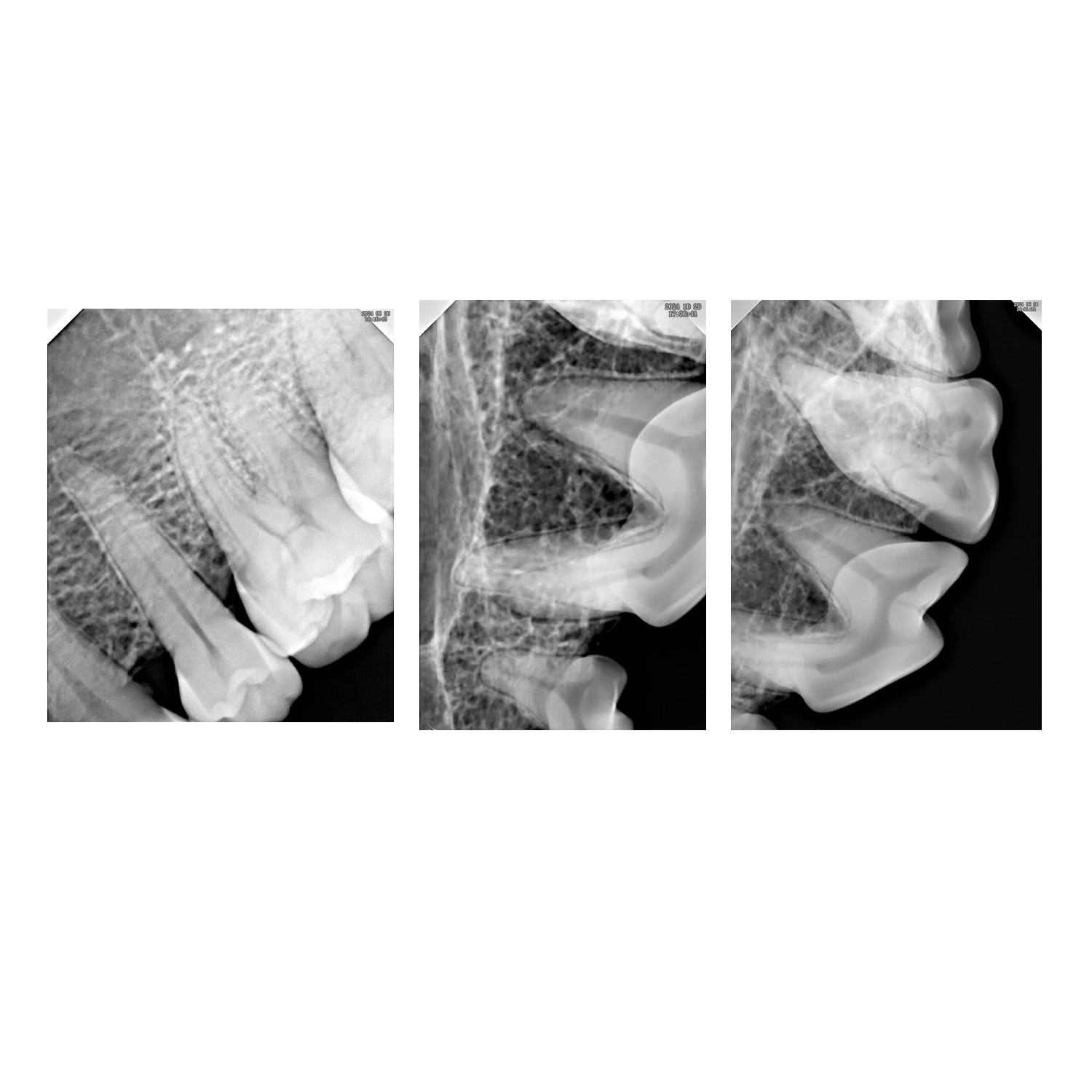 Dental Implant Surgical Sensor X-Ray Radiovisiograph Portable Digital HD Image Camera Digital RVG Detector for Dental Image Use