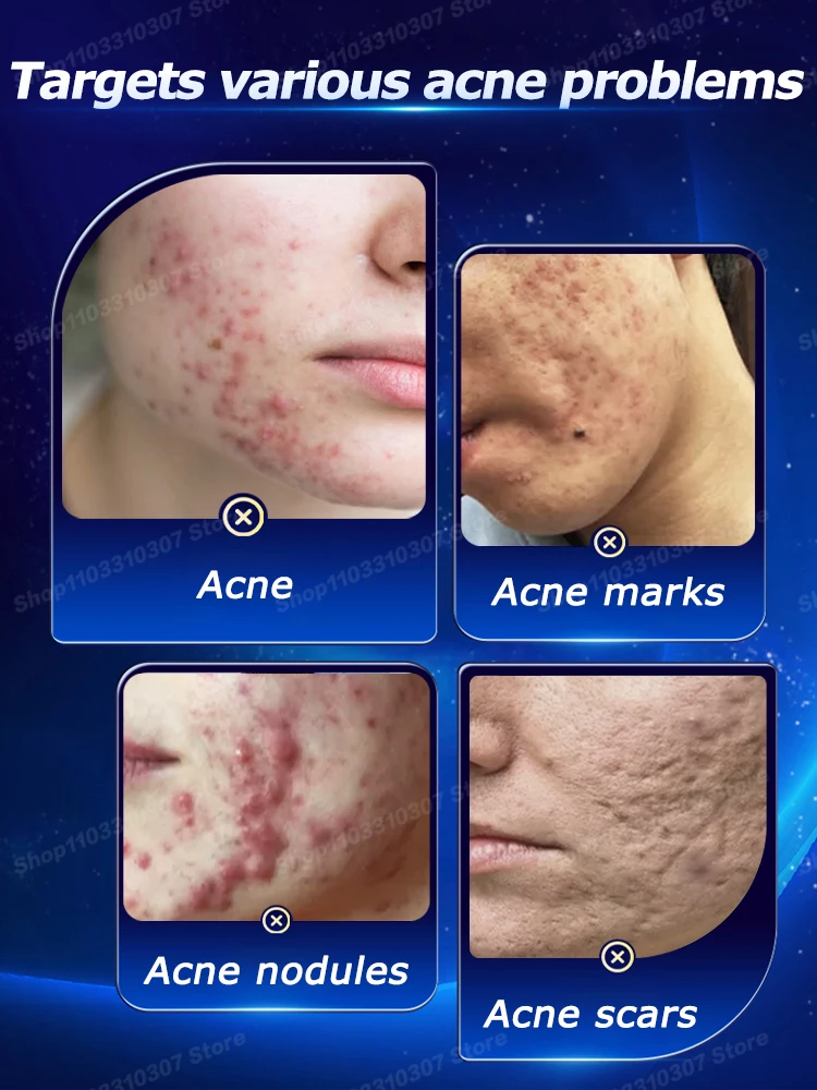 Acne Treatment Cream Repair Pimple Spots Deep Cleaning Pore Shrinking Control Moisturizer Skin Care