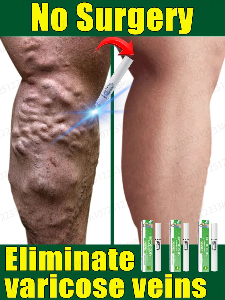 Varicose Vein Removal, New Laser Varicose Vein Removal. Black technology