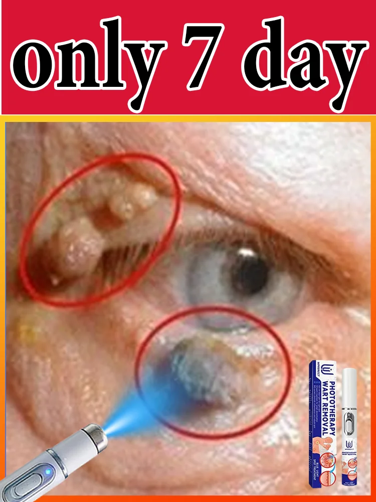 Gᴇɴᴇʀᴀᴛɪᴏɴ-3 Lᴀsᴇʀ Sᴀʏs Gᴏᴏᴅʙʏᴇ Tᴏ Wᴀʀᴛs Iɴ 7 Dᴀʏs