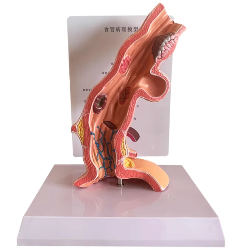 modello-esofageo-umano-modello-anatomico-del-sistema-digestivo-dell'erosi-polipelo-esofagnolo-umano-sussidi-didattici-medici