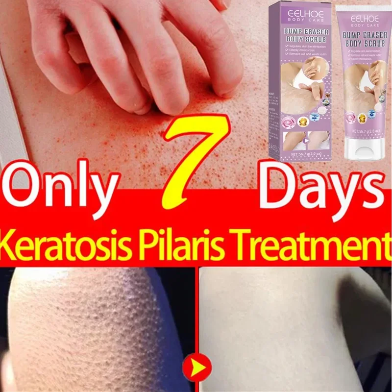 Crema hidratante de Queratosis Pilaris para el cuidado de la piel corporal, eliminador de piernas de fresa, borrador de golpe KP, exfoliante corporal, productos para el cuidado de la piel