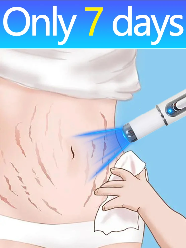 

free shipping, blue light pen solve Stretch marks,Stretch care tools, unisex Help people with Stretch marks solve their problems