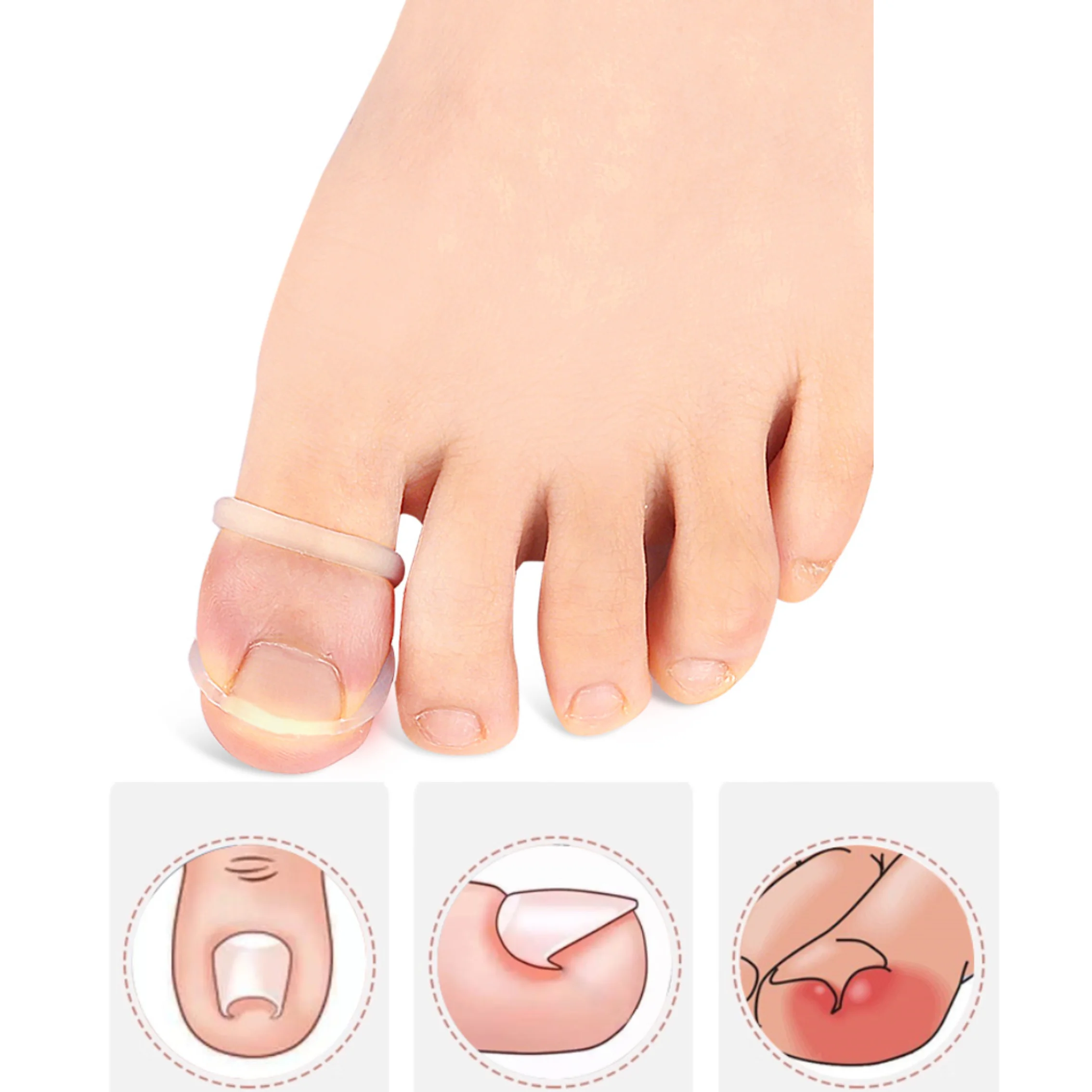 10Pcs Silicone Invisible Ingrown Toenail Correction Treatment Recover Corrector Clip Brace Pedicure Care Tool