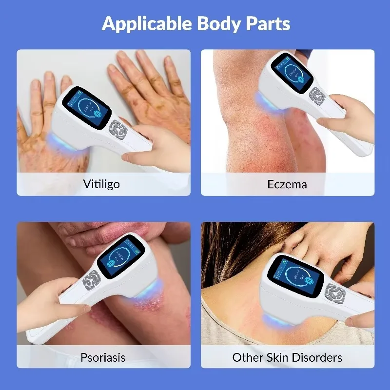 GOVW 308nm Ultraviolet Light Treatment Excimer Laser Therapy Device 49 LEDs for Psoriasis Vitiligo Skin Inflammation Therapy