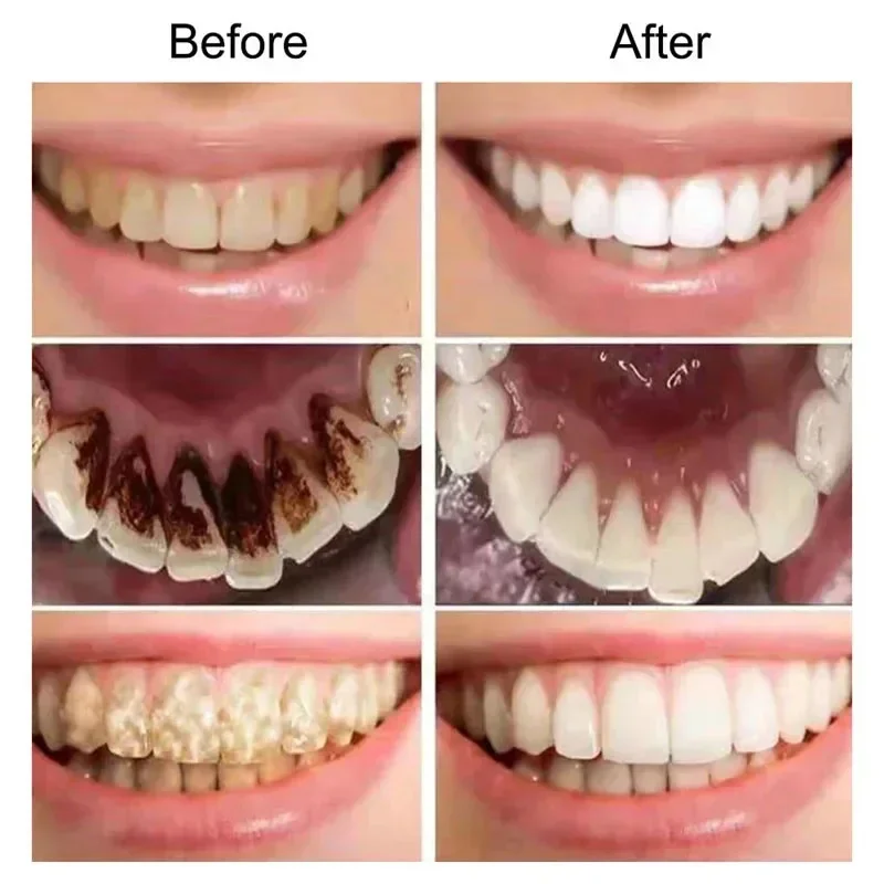 V34 ฟันไวท์เทนนิ่งมูสยาสีฟันฟัน Whitener ลบคราบ Plaque Corrector Oral สุขอนามัยทําความสะอาดทันตกรรมเครื่องมือฟอกสีฟัน