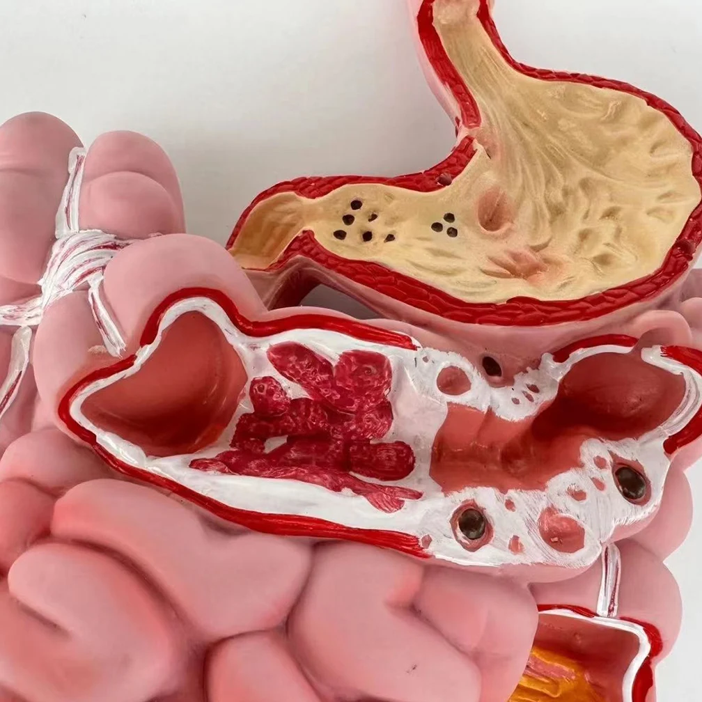 Adult Large Intestinal Pathology Model Human Digestive System Anatomy Model Medical Teaching Tools Gastrointestinal Lesions