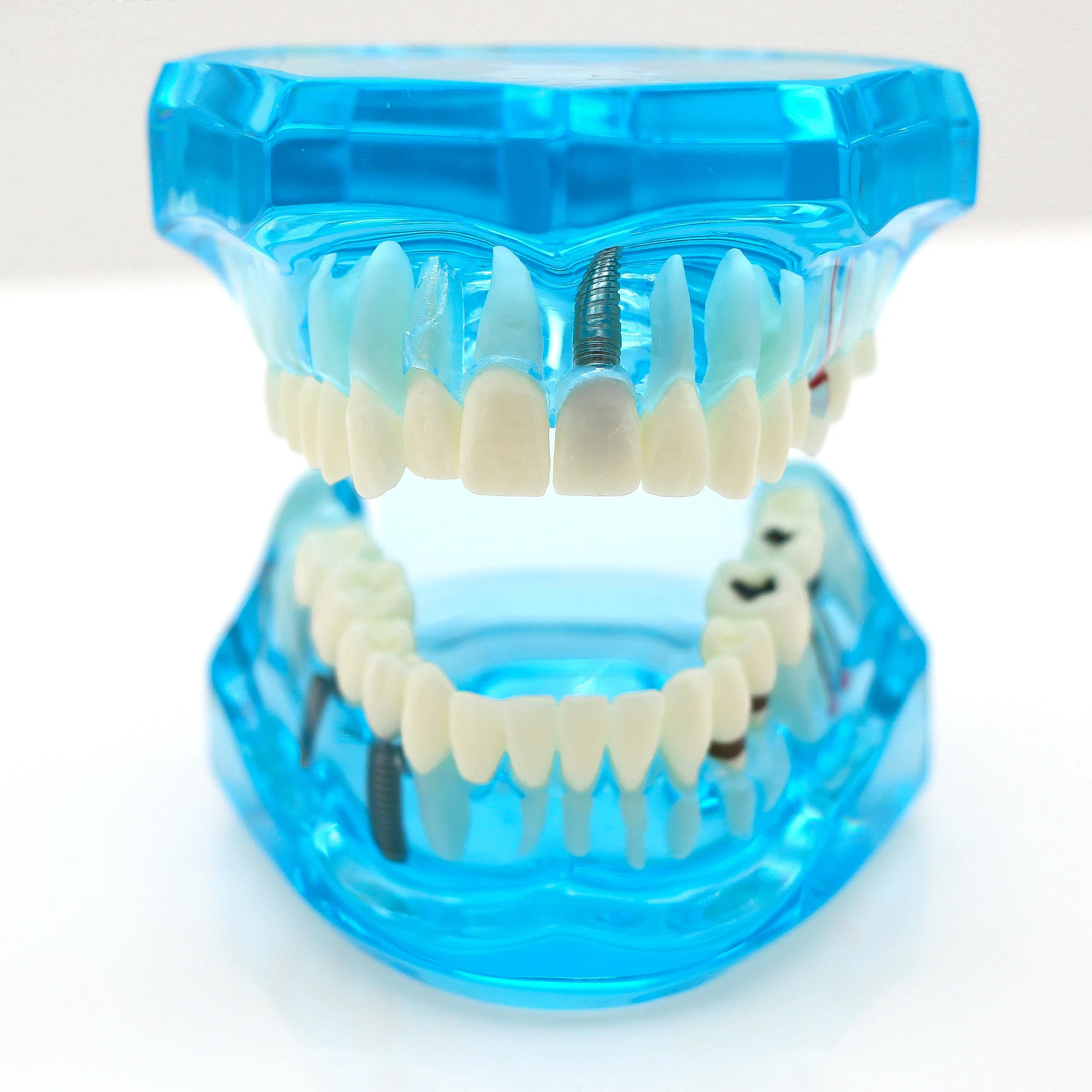 نموذج ترميم زرع الأسنان نموذج لتدريس طبيب الأسنان دراسة طب الأسنان منتجات طب الأسنان المعيار الأزرق 1:1 #6