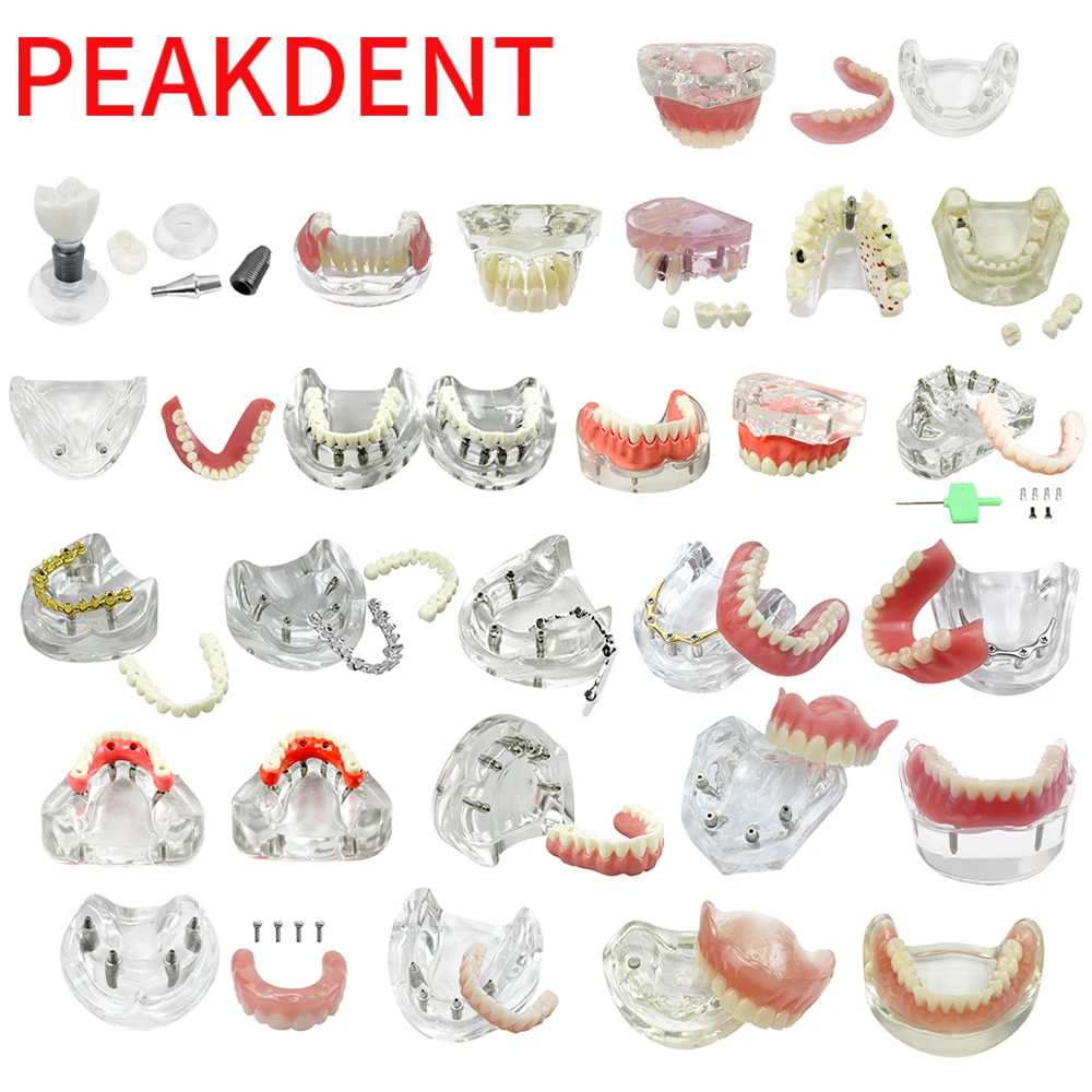 Dental Implant Restoration Teeth Model Removable Overdenture Model With Upper Lower Jaw 2/4/6 Implants Dentist Education Model