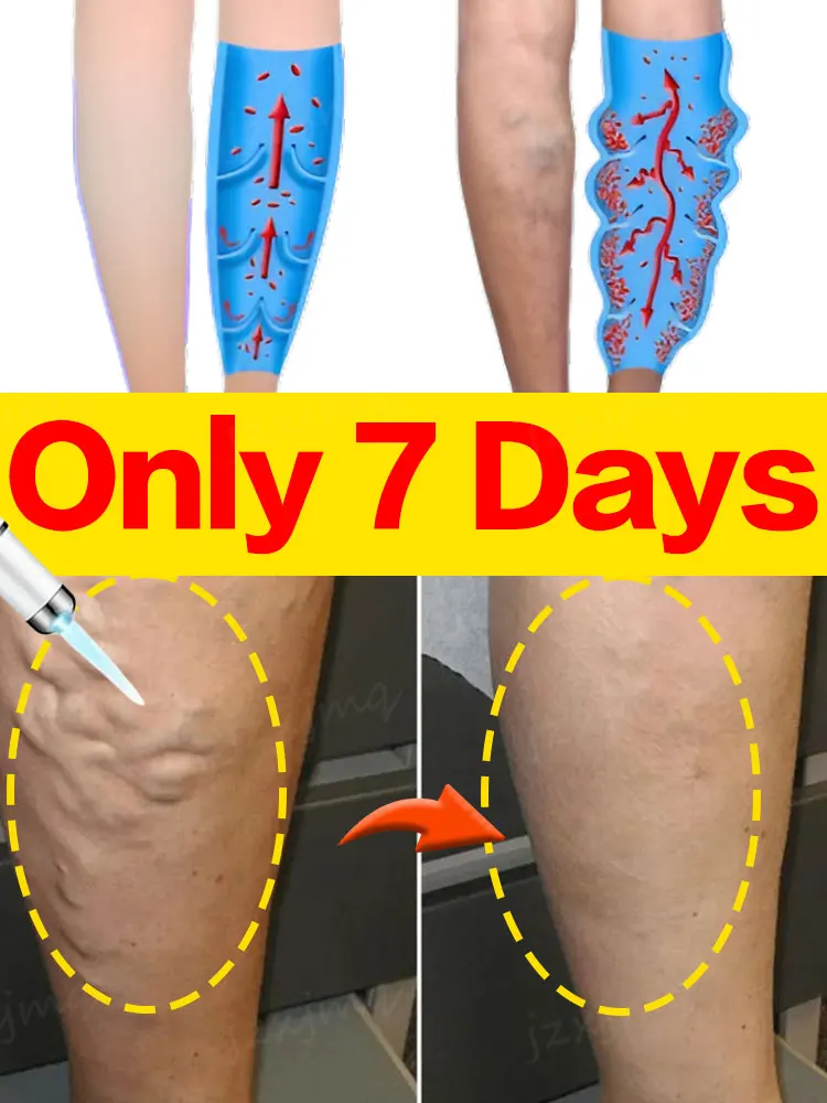 

High Tech Laser Therapy Improves Moderate Varicose Veins Relieves Pain