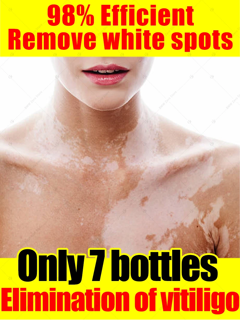 

The most powerful black technology in 2025 will completely solve the problem of vitiligo!