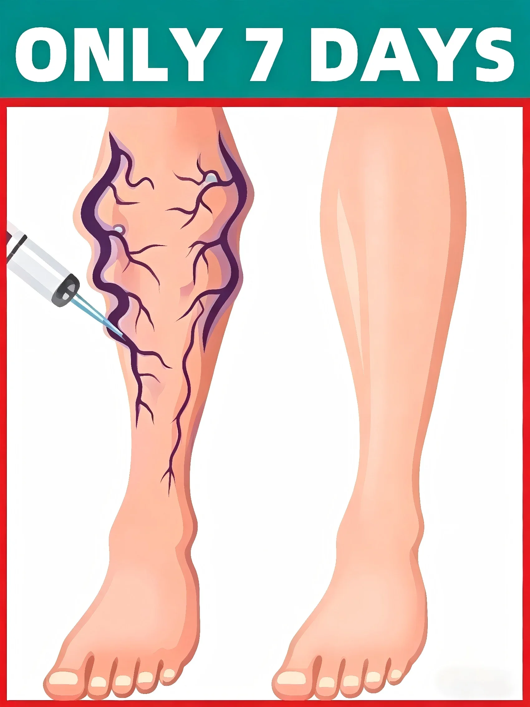 

A new type of nano-laser device treats varicose veins caused by prolonged sitting or standing.
