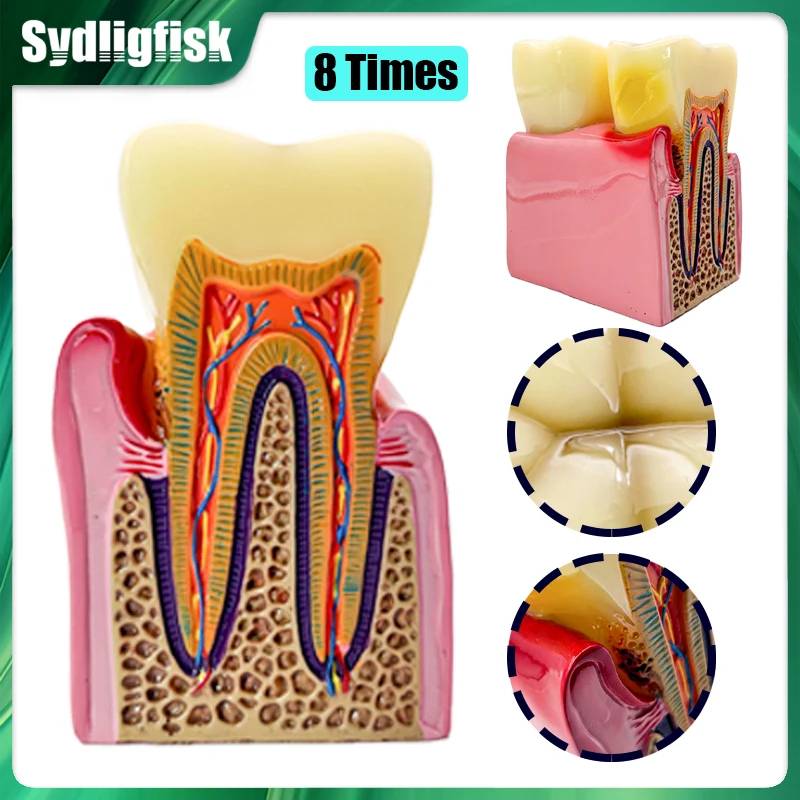 8 Times Dental Caries Teeth Model Periodontitis Case Analysis Teeth Model Dental Anatomy Teaching Studying Demonstration Model