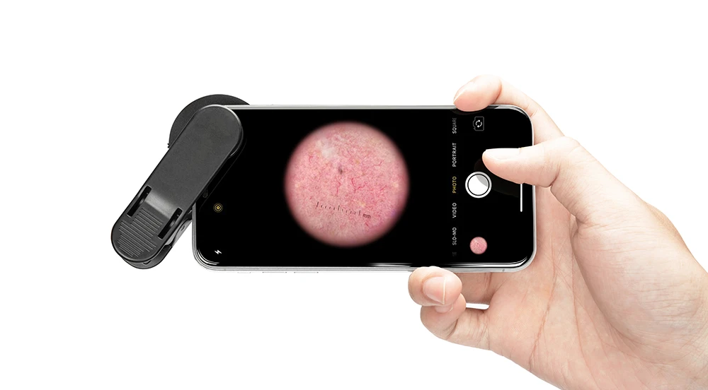 DE300 Metal Dermatoscope and LED Light 2-Mode Pocket Polarized Manual Power Source clinical dermatoscope equipment with adapter