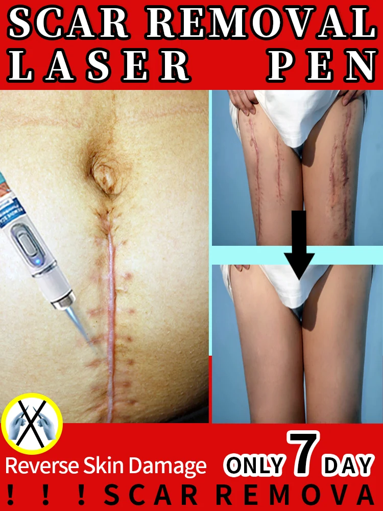 

ᶠⁱʳˢᵗ ᵖˡᵃᶜᵉ ⁱⁿ ˢᶜᵃʳ ʳᵉᵖᵃⁱʳ ᵃⁿᵈ ʳᵉᵐᵒᵛᵃˡ,Easily and quickly remove scars