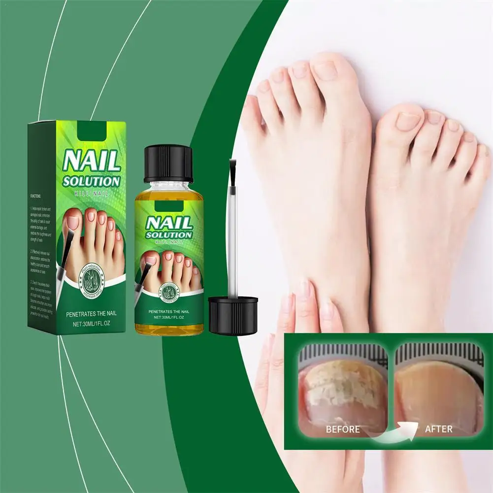 30ml Extra Strong Nail Fungus Treatment Serum Essence Oil Feet Nails Repair Care Anti Infection Toe Fungal Removal Gifts