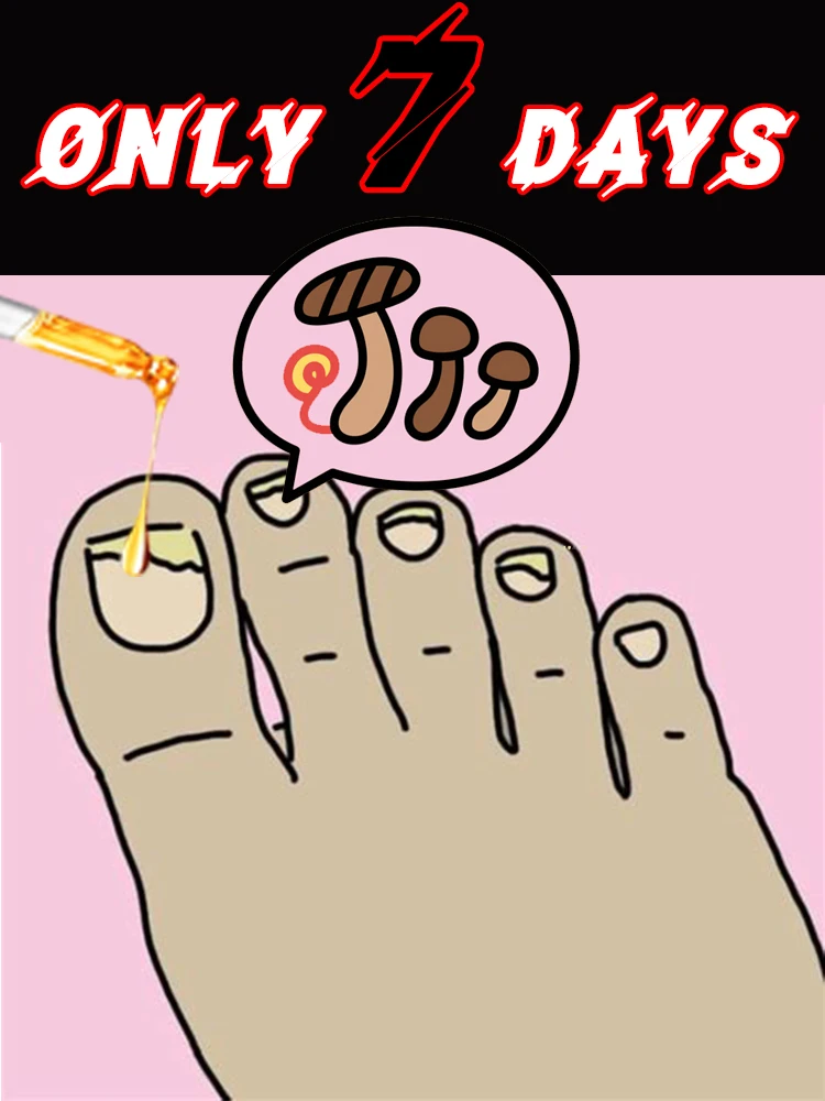 قطرات تقوية الأظافر، آمنة من الاتحاد الأوروبي/KR، دعم أظافر القدم السميكة والهشة، 10 مل