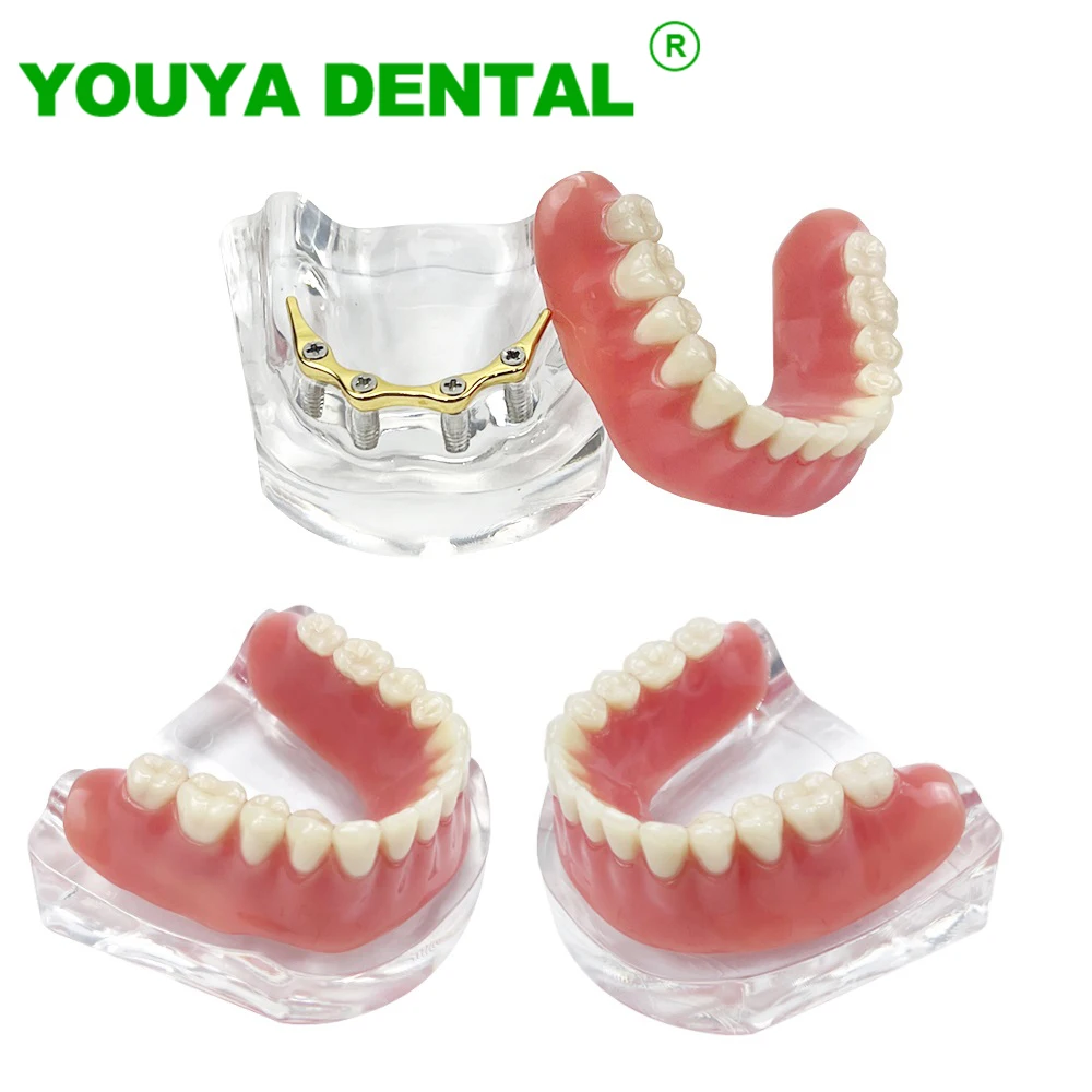 Dental Teeth Implant Model With Clear Upper 4 Implants Overdenture Restoration Model M6009 Typodont Golden Bar Superior Models