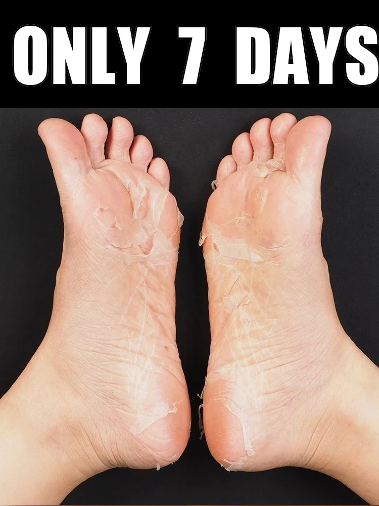 7-Dᴀʏ Fᴏᴏᴛ Pᴇᴇʟ Mᴀsᴋ ғᴏʀ Dʀʏ, Rᴏᴜɢʜ, Cʀᴀᴄᴋᴇᴅ Fᴇᴇᴛ, Hᴇᴇʟs, ᴀɴᴅ Cᴀʟʟᴜsᴇs