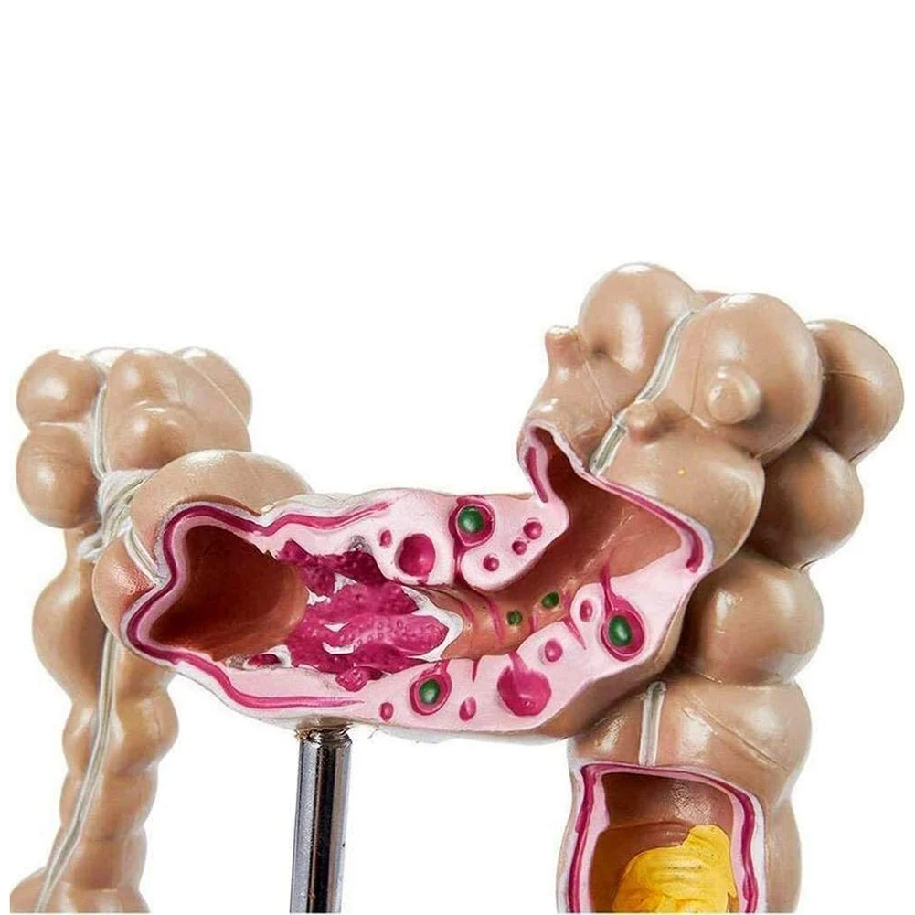 Modelo de cáncer coloreatural patológico del colon Modelo de intestino grueso Modelo anatómico gastrointestinal