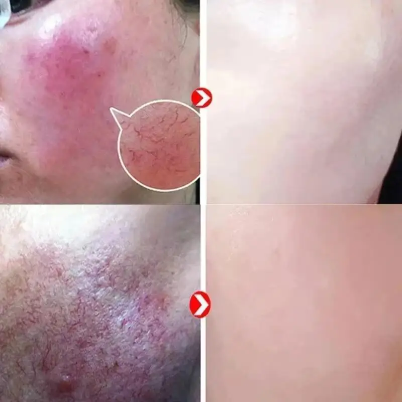 Repair Facial Redness Cream Instant Spider Vein Remove Sensitive Skin Sooth Anti Redness Rosacea Treat Lotion Korean Cosmetics