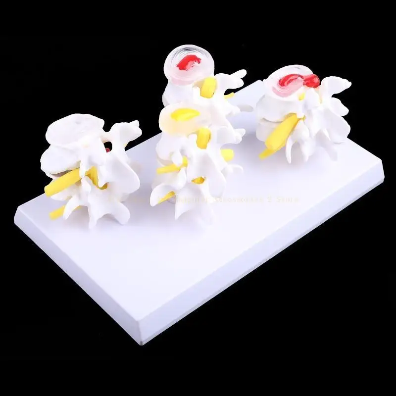 1 Set Human Lumbar Lesion Spine Statue Display Model Medical Teaching Learning f