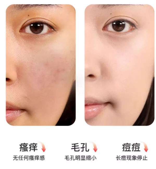 Gratis Verzending Huishoudelijke Gezichtsmijten Instrument Ozon Acne Verwijdering Acne Markeringen Acne Ontstekingsremmende Lichtvlek Schoonheid