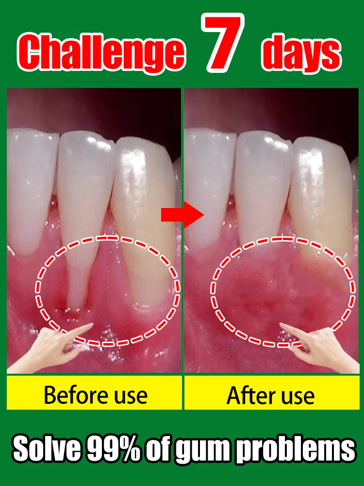 

For gum bleeding, gum atrophy repair, loose teeth, and beautiful gums