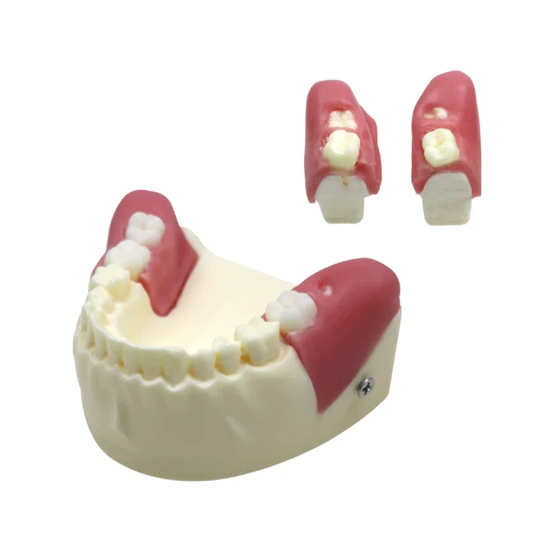 GREATLH Dental Impacted Tooth Extraction Practice Model Wisdom Tooth Training Teeth Model Dental Training Product for Students