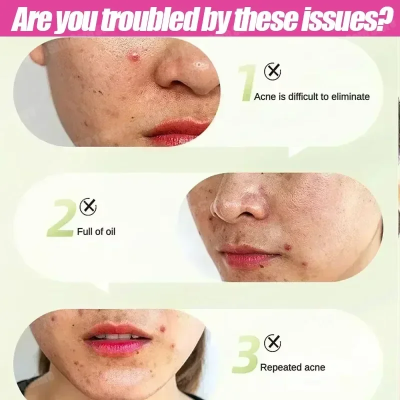 

38Skincare Acne products, professional formula, soothe acne, restore healthy skin shine. Cream