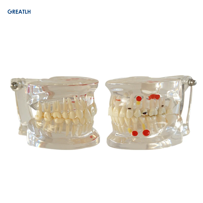 

Dental Standard Tooth Model Orthodontic Model for Patient Communication Dental Study Clinic