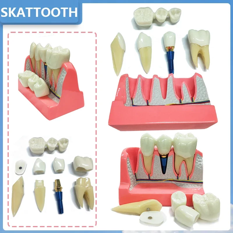 4 Times Dental Implant Teeth model Crown Bridge Demonstration Removable Model Porcelain Teeth Dental Teaching Model for Dentist