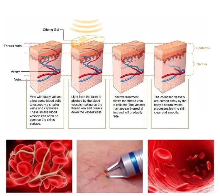 Spider Vein Removal Vascular Treatment Onychomycosis Toe Nail Fungus Treatment high frequency rf spider vein removal machine