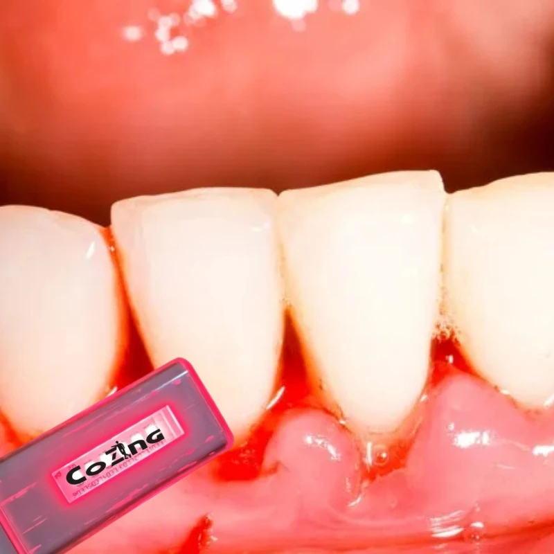 

COZING USBO Medical Laser Applicator Home Therapy for Chronic Pharyngitis and Oral Inflammation