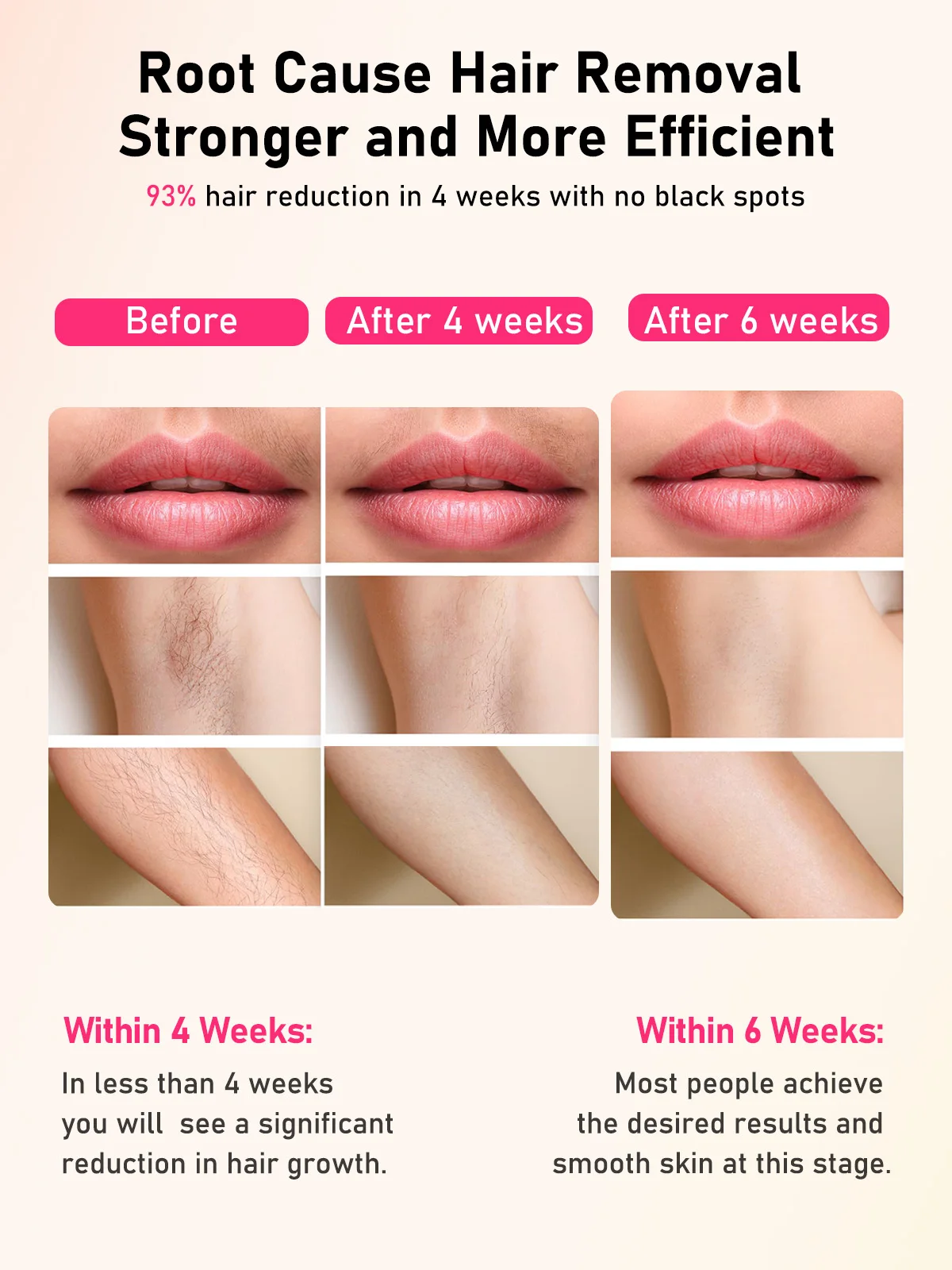 Thumbnail 4 - #35 Trending Hair Removal Devices Right Now