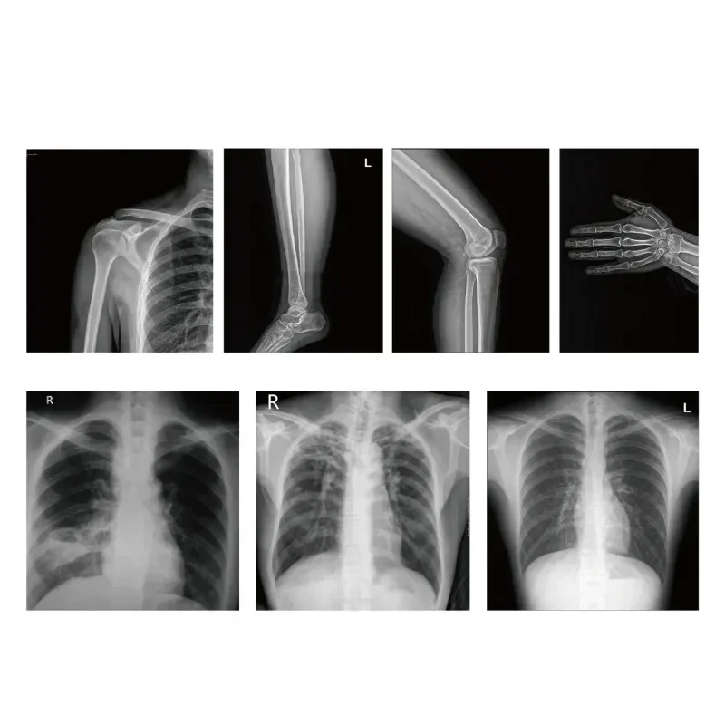 رائجة البيع الطبية الساخنة عالية التردد آلة الأشعة السينية المتنقلة المحمولة نظام التصوير السريع DR