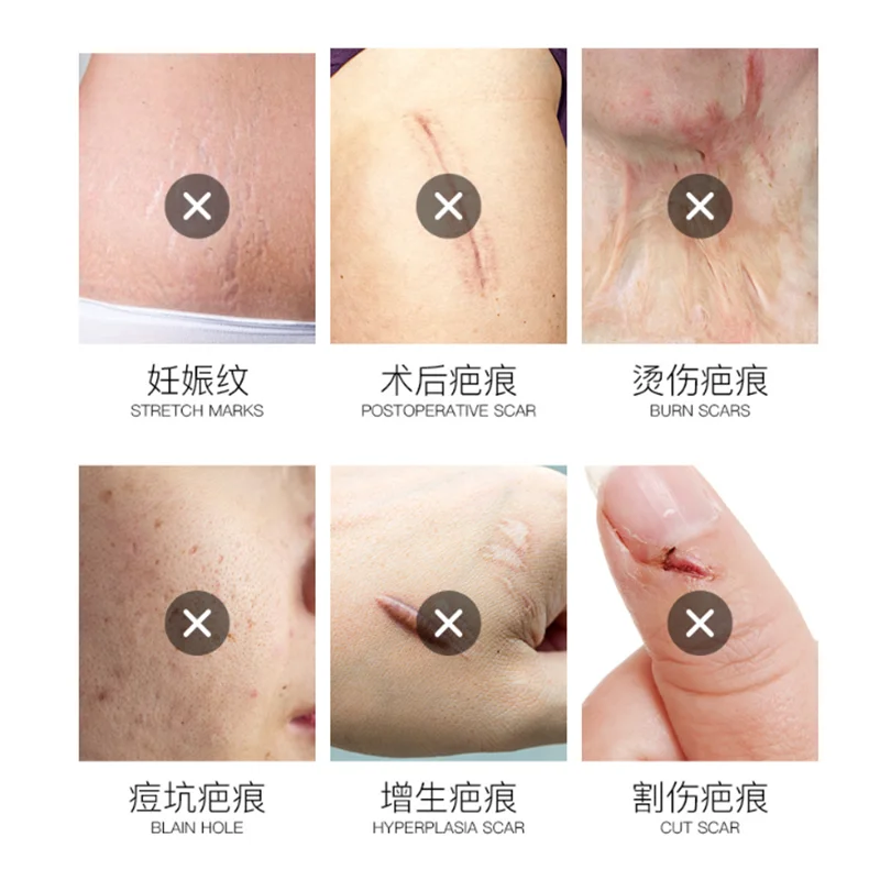 30ml Scar Repair Cream Fade Burns Burns Old Scars Acne Scars Surgical Scars Smoothing Skin Scar Cream Free Shipping