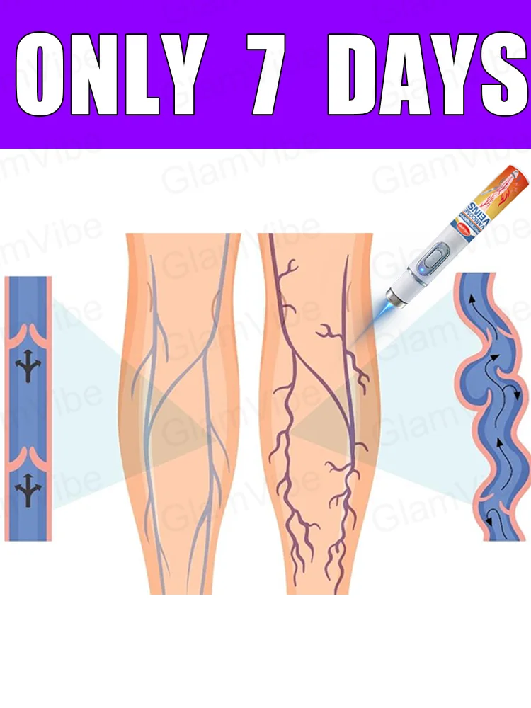 

blue light pen solve varicose veins, hot sale leg care tools