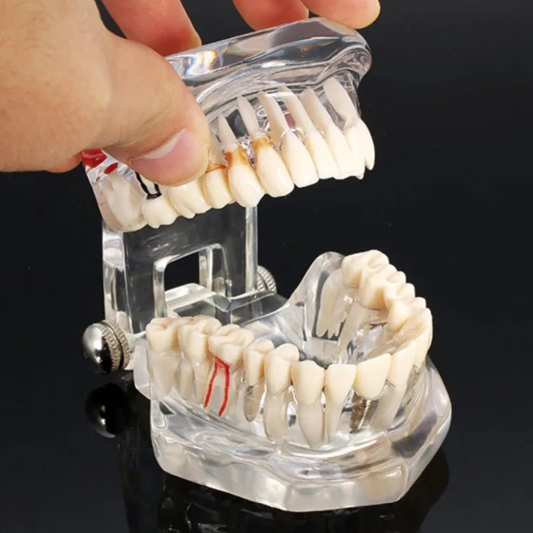Dentalmodelle reparierbare Harzmodelle für erkrankten Zähne für den Unterricht und Forschung in Medizin und Zahnkrankungen – Detail 2