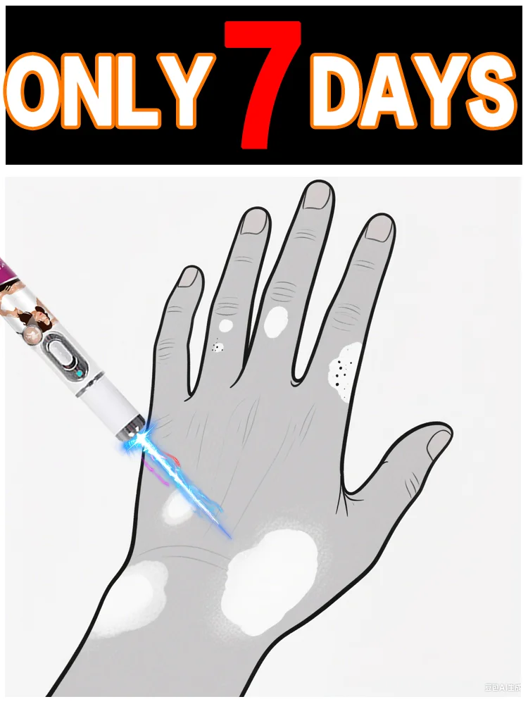 Vitiligo Treatment Device 2nd Upgraded Version⸴Vitiligo Treatment⸴Fast