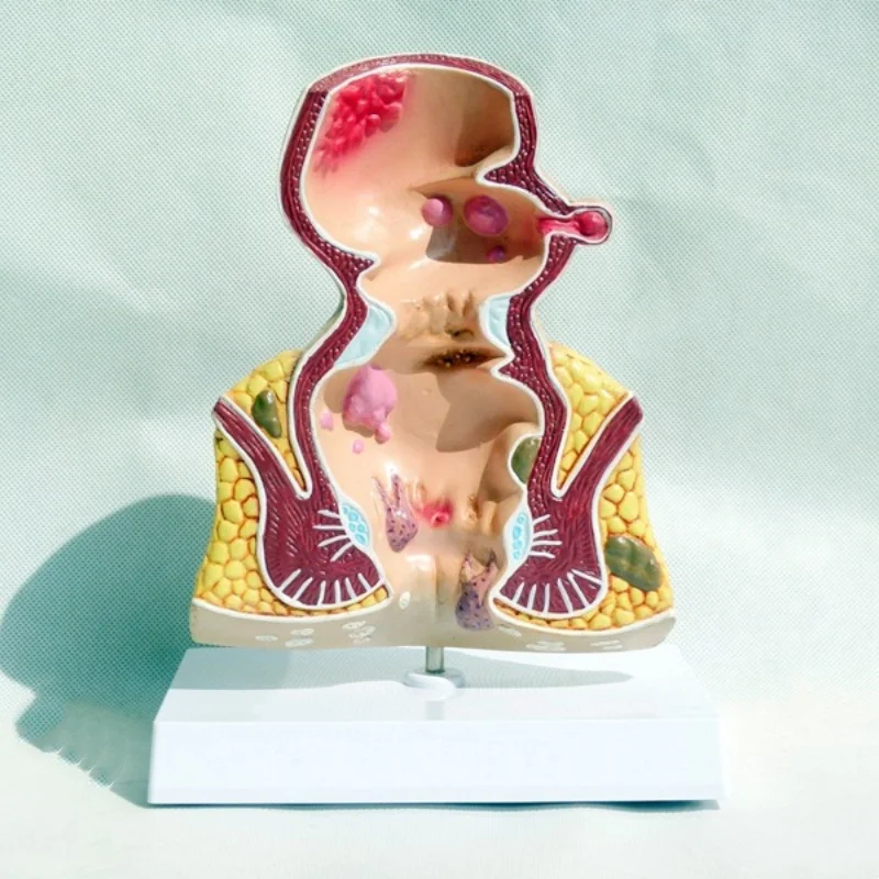 

Высококачественная модель поражения прямольного геморроя