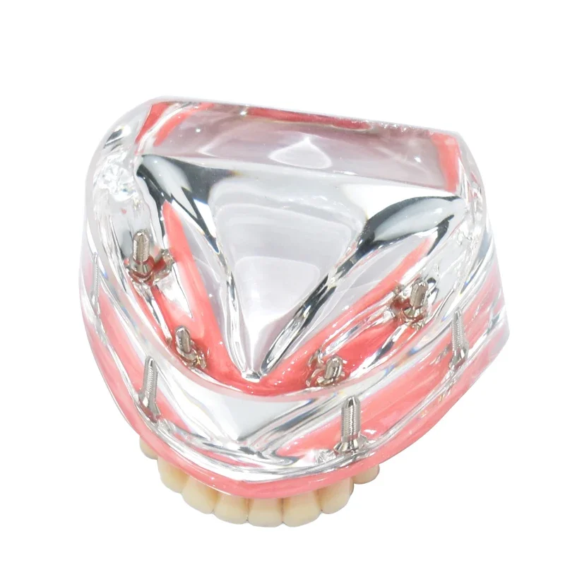 نموذج لشكل الأسنان M6003 مع زرع الأسنان الزائدة التجريبي السفلي للفك السفلي من الأكريليك الشفاف يسمح قاعدة الفك السفلي
