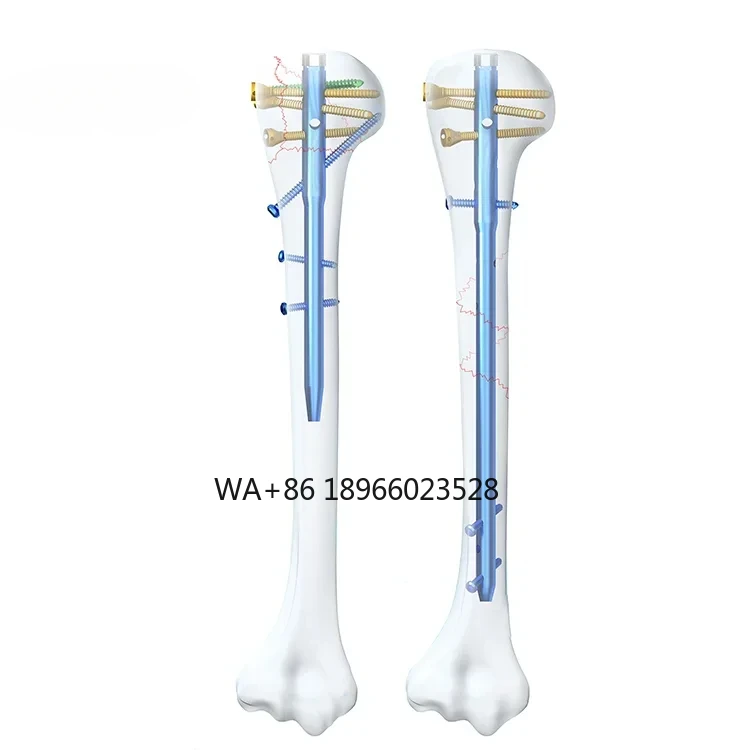 Implants Titanium With Locking Screw Multiloc Humeral Intramedullary Nail Interlocking