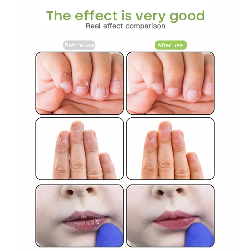 Baby Bitter Nail Water 10ml Dzieci Dorośli Paznokcie przeciw ukąszeniom Gorzka woda do paznokci Leczenie paznokci w płynie Przeciw ukąszeniom Długopis do ssania kciuka